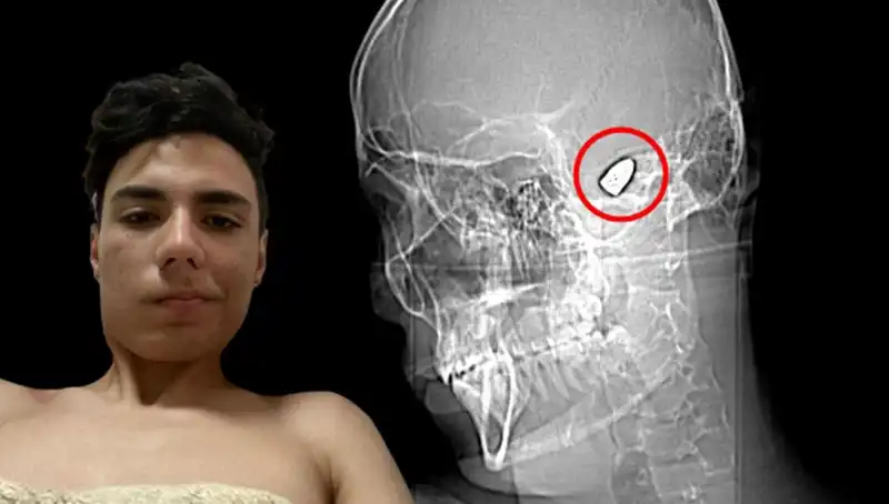 Kafasının İçinde Patlamaya Hazır Bomba Taşıyan Adamın Yaşadığı Korku Dolu Anlar
